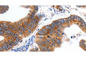 Immunohistochemistry of paraffin-embedded Human colon cancer tissue using KCNC2 Polyclonal Antibody at dilution 1:100 (KCNC2 anticorps)