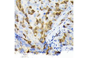 Immunohistochemistry of paraffin-embedded human breast cancer using Thymidine Kinase 1 Rabbit pAb (ABIN6132726, ABIN6149198, ABIN6149199 and ABIN6221245) at dilution of 1:100 (40x lens). (TK1 anticorps  (AA 1-234))