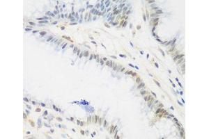 Immunohistochemistry of paraffin-embedded Human stomach using IGF2BP3 Polyclonal Antibody at dilution of 1:200 (40x lens). (IGF2BP3 anticorps)