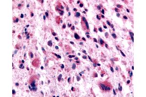 Anti-GABABR1 / GABBR1 antibody IHC of human Brain, Glioblastoma.