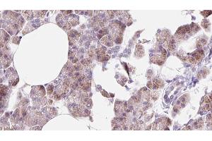 ABIN6273225 at 1/100 staining Human pancreas cancer tissue by IHC-P. (DCTN6 anticorps  (Internal Region))