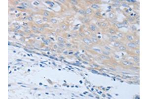 The image on the left is immunohistochemistry of paraffin-embedded Human cervical cancer tissue using ABIN7190248(CHRFAM7A Antibody) at dilution 1/40, on the right is treated with synthetic peptide. (CHRNA7 anticorps)