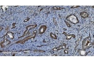 IHC analysis of PARP using anti-PARP antibody (ABIN7602277). (PARP1 anticorps  (AA 670-858))