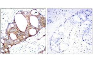 Immunohistochemical analysis of paraffin-embedded human breast carcinoma tissue using GSK3a(Phospho-Ser21) Antibody(left) or the same antibody preincubated with blocking peptide(right). (GSK3 alpha anticorps  (pSer21))
