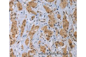 Immunohistochemistry of Human thyroid cancer using CLEC1A Polyclonal Antibody at dilution of 1:40 (CLEC1A anticorps)
