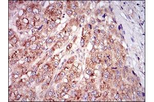 Immunohistochemical analysis of paraffin-embedded liver cancer tissues using MSTN mouse mAb with DAB staining. (MSTN anticorps  (AA 24-266))