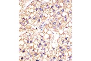 (ABIN387816 and ABIN2843905) staining EGFR in human hepatic carcinoma sections by Immunohistochemistry (IHC-P - paraformaldehyde-fixed, paraffin-embedded sections). (EGFR anticorps)
