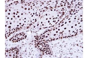 Immunohistochemical staining of paraffin-embedded Cal27 Xenograft using hnRNP C1/C2 antibody at a dilution of 1:100 (HNRNPC anticorps)