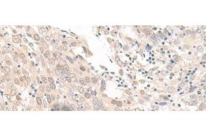 Immunohistochemistry of paraffin-embedded Human prost at e cancer tissue using OLA1 Polyclonal Antibody at dilution of 1:45(x200) (OLA1 anticorps)