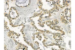 HSP60 Mouse Monoclonal Antibody at 1/100 staining human ovarian cancer by IHC-P.