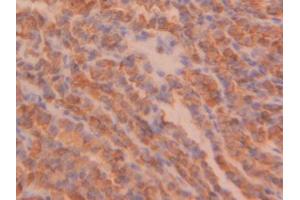 DAB staining on IHC-P; Samples: Human Thyroid cancer Tissue