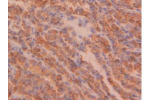 DAB staining on IHC-P; Samples: Human Thyroid cancer Tissue (PPIB anticorps  (AA 47-216))