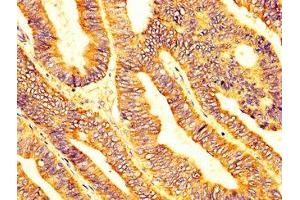 IHC image of ABIN7158752 diluted at 1:200 and staining in paraffin-embedded human colon cancer performed on a Leica BondTM system.