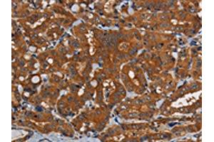 The image on the left is immunohistochemistry of paraffin-embedded Human thyroid cancer tissue using ABIN7191822(PDE5A Antibody) at dilution 1/50, on the right is treated with synthetic peptide.