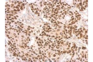 IHC-P Image Lamin B2 antibody [N3C2], Internal detects LMNB2 protein at on Cal27 xenograft by immunohistochemical analysis.