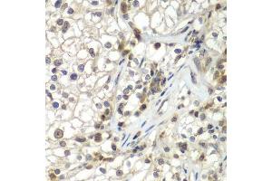 Immunohistochemistry of paraffin-embedded human kidney cancer using ASPSCR1 antibody. (ASPSCR1 anticorps  (AA 284-553))
