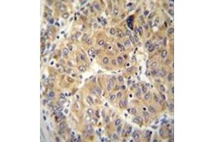 Immunohistochemistry analysis in formalin fixed and paraffin embedded human hepatocarcinoma reacted with NARS Antibody (N-term) followed which was  peroxidase conjugated to the secondary antibody and followed by DAB staining.