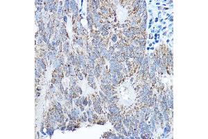 Immunohistochemistry of paraffin-embedded human colon carcinoma using SMOC1 antibody (ABIN7270511) at dilution of 1:250 (40x lens).