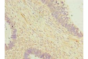 Immunohistochemistry of paraffin-embedded human ovarian cancer using ABIN7149808 at dilution of 1:100 (OTUD6B anticorps  (AA 1-293))