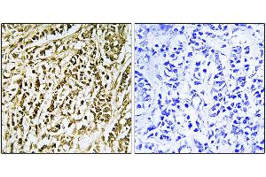 Immunohistochemistry analysis of paraffin-embedded human breast carcinoma tissue using FEN1 antibody. (FEN1 anticorps)