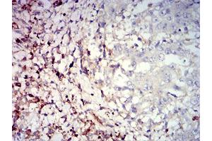 Immunohistochemical analysis of paraffin-embedded stomach cancer tissues using CD39 mouse mAb with DAB staining.
