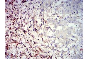 Immunohistochemical analysis of paraffin-embedded stomach cancer tissues using CD39 mouse mAb with DAB staining. (CD39 anticorps  (AA 38-179))