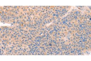 Immunohistochemistry of paraffin-embedded Human liver cancer tissue using CD109 Polyclonal Antibody at dilution 1:30 (CD109 anticorps)