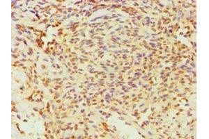 Immunohistochemistry of paraffin-embedded human breast cancer using ABIN7170761 at dilution of 1:100