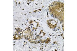 Immunohistochemistry of paraffin-embedded human breast cancer using NCF4 Antibody (ABIN5971122) at dilution of 1/100 (40x lens). (NCF4 anticorps)