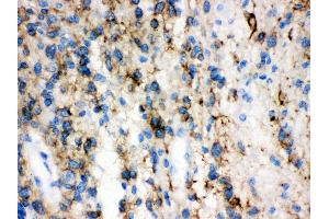 Anti-GAP43 antibody, IHC(P) IHC(P): Human Glioma Tissue (GAP43 anticorps  (C-Term))