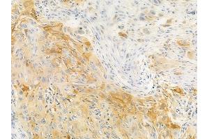 ABIN6256940 and ABIN6274855 at 1/100 staining human tongue carcinoma by IHC-P. (Apolipoprotein F anticorps  (C-Term))