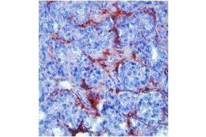 MMP9 in humanprostate cancer was detected using HRP/AEC red color stain. (MMP 9 anticorps  (N-Term))