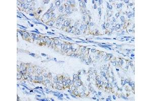 Immunohistochemistry of paraffin-embedded Human colon carcinoma using VIL1 Polyclonal Antibody at dilution of 1:100 (40x lens). (Villin 1 anticorps)