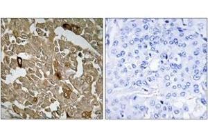 Immunohistochemistry analysis of paraffin-embedded human breast carcinoma tissue, using BTBD6 Antibody. (BTBD6 anticorps  (AA 91-140))
