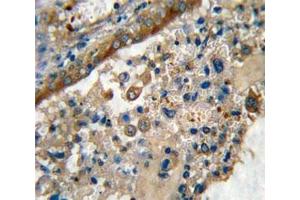 IHC analysis of FFPE human lung carcinoma stained with GARP antibody