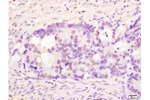 Formalin-fixed and paraffin embedded human colon carcinoma labeled with Anti PMS1 Polyclonal Antibody, Unconjugated (ABIN1387537) at 1:200 followed by conjugation to the secondary antibody and DAB staining (PMS1 anticorps  (AA 21-120))