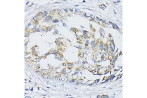 Immunohistochemistry of paraffin-embedded human mammary cancer using SLC30 antibody (2532) at dilution of 1:100 (40x lens). (SLC30A1 anticorps  (AA 250-350))