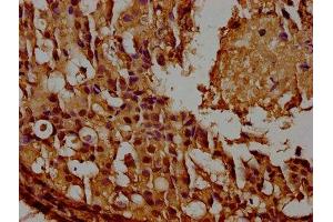 IHC image of ABIN7153644 diluted at 1:100 and staining in paraffin-embedded human breast cancer performed on a Leica BondTM system.