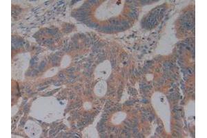 Detection of CFH in Human Rectum Cancer Tissue using Polyclonal Antibody to Complement Factor H (CFH)