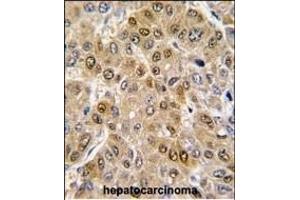 Formalin-fixed and paraffin-embedded human hepatocarcinoma tissue reacted with DDX5 antibody (C-term) (ABIN391668 and ABIN2841579) , which was peroxidase-conjugated to the secondary antibody, followed by DAB staining.