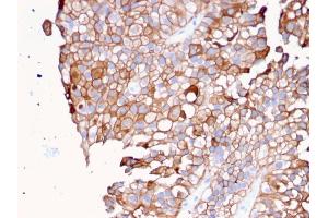 Formalin-fixed, paraffin-embedded human Urothelial Carcinoma stained with Uroplakin 1B Mouse Monoclonal Antibody (UPK1B/3081). (Uroplakin 1B anticorps  (AA 109-229))