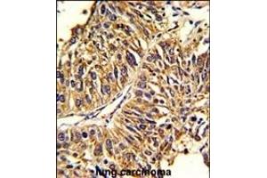 Formalin-fixed and paraffin-embedded human lung carcinoma reacted with HMGCS1 Antibody (Center), which was peroxidase-conjugated to the secondary antibody, followed by DAB staining.