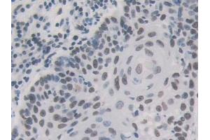 Detection of HNRNPA1 in Human Skin cancer Tissue using Polyclonal Antibody to Heterogeneous Nuclear Ribonucleoprotein A1 (HNRNPA1)