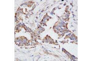 Anti-Osteopontin antibody, IHC(P) IHC(P): Human Mammary Cancer Tissue (Osteopontin anticorps  (N-Term))
