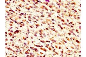 IHC image of ABIN7159800 diluted at 1:300 and staining in paraffin-embedded human glioma performed on a Leica BondTM system. (m1ip1 anticorps  (AA 1-183))
