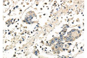 ABIN6261815 and ABIN6278146 at 1/100 staining Human gastric cancer by IHC-P. (FRAT1 anticorps  (C-Term))