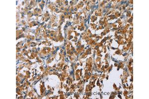 Immunohistochemistry of Human cervical cancer using CARD9 Polyclonal Antibody at dilution of 1:60