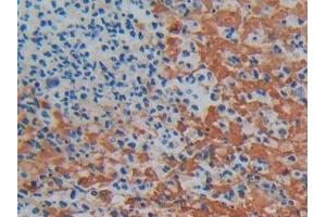 Detection of PTGES2 in Human Colorectal cancer Tissue using Polyclonal Antibody to Prostaglandin E Synthase 2 (PTGES2)