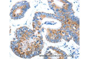 Immunohistochemistry of Human colon cancer using AIFM1 Polyclonal Antibody at dilution of 1:30 (AIF anticorps)