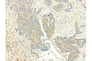 ABIN6266056 and ABIN6268656 at 1/100 staining Human breast cancer by IHC-P. (XBP1 anticorps  (C-Term))